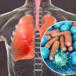 Viral Pneumonia Treatments