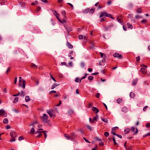 Viral Pneumonia Treatments