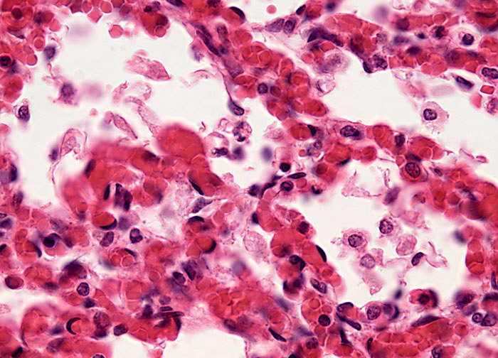 Viral Pneumonia Treatments