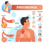 Which Viral Pneumonia Treatments Ease Chest Congestion