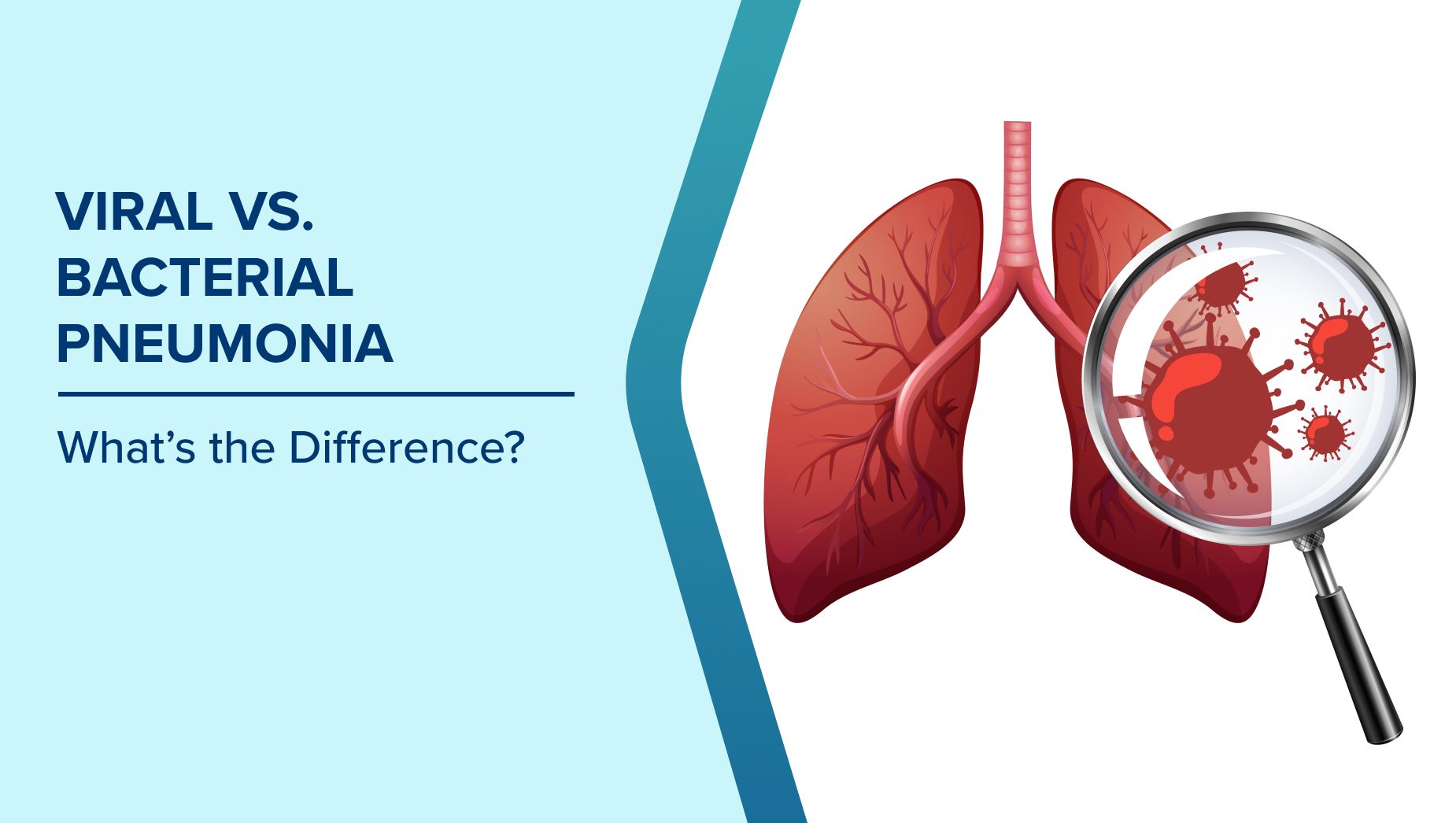 When Viral Pneumonia Treatments Work Better Than Antibiotics