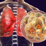 How Viral Pneumonia Treatments Support Breathing Recovery