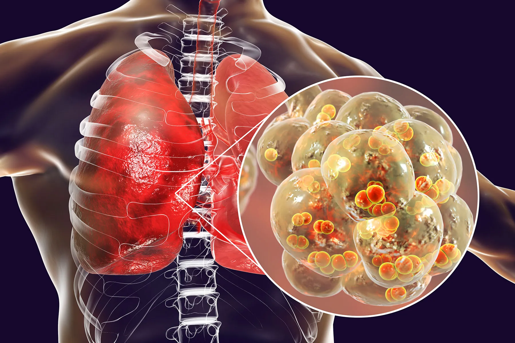 How Viral Pneumonia Treatments Support Breathing Recovery