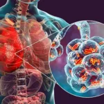 What Viral Pneumonia Treatments Provide For At-Risk Groups