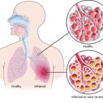 How Viral Pneumonia Treatments Aid Immune Response